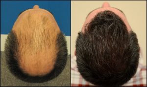 Trasplante de cabello natural - Although there is no clear cure for this condition, there are ways in which we can stop it and even reverse it, one of them is the natural hair transplant.